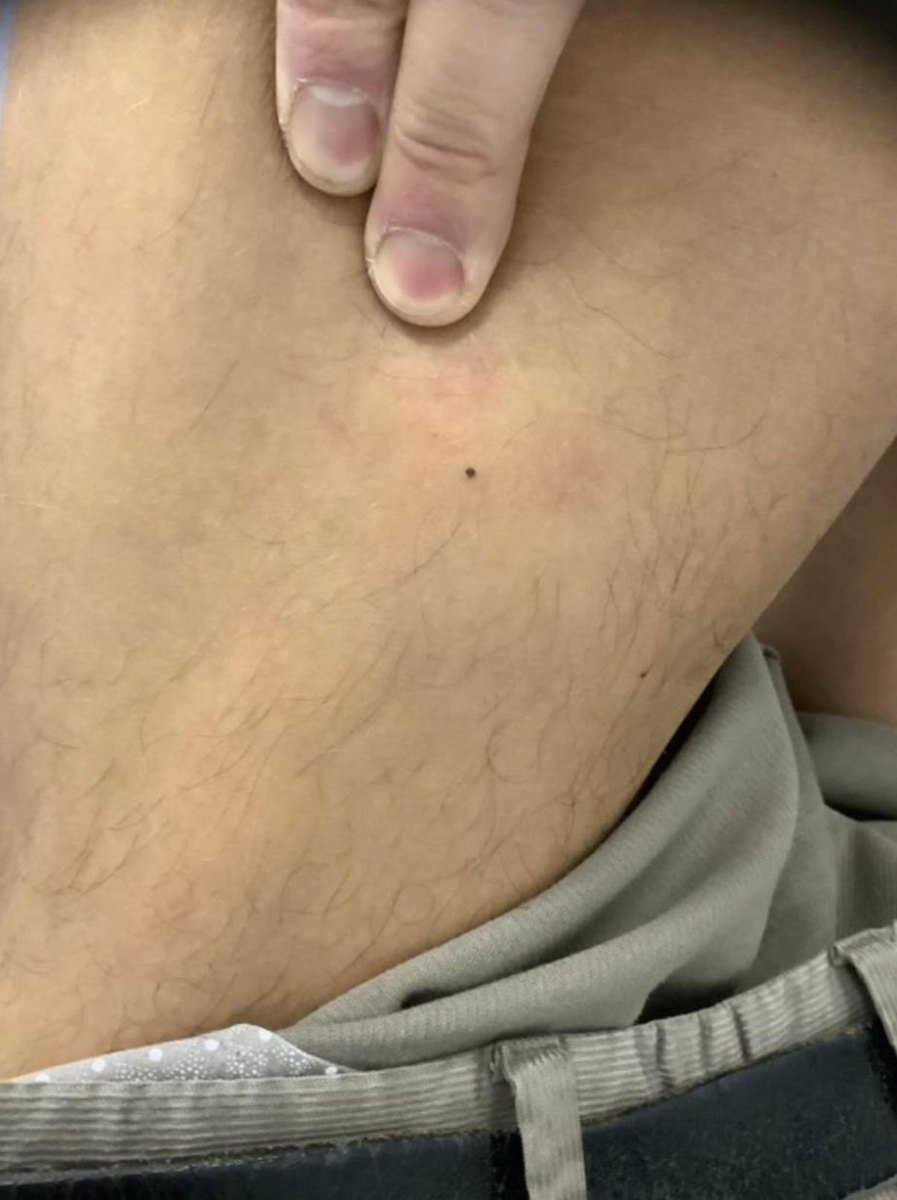 Melanoma in situ on the outer side of a patient's left thigh: a tiny dark dot that is easy to mistake for a harmless mole
