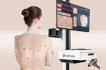 Digital dermoscopy with the FotoFinder system: a map of moles on a patient's back and lesion images on the monitor