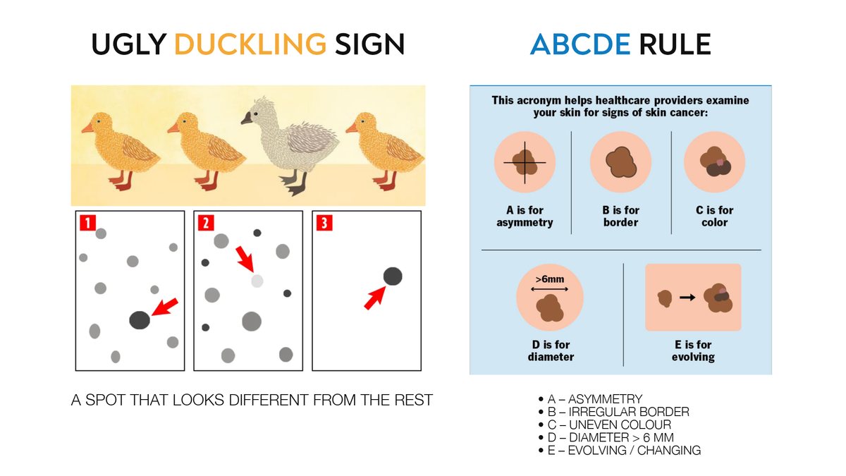 The ugly duckling sign and the ABCDE rule: a mole that looks different from the rest, asymmetry, irregular border, uneven colour, diameter over 6 mm, evolving